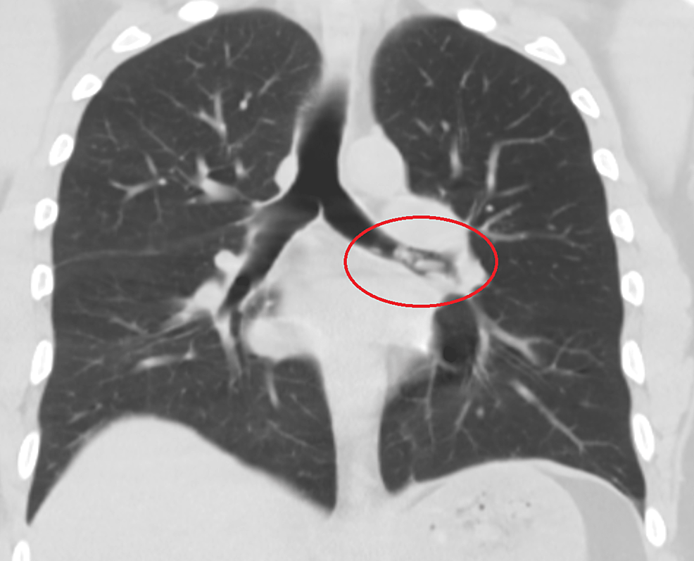 The-chest-computed-tomography-without-contrast-revealed-multiple-nodular-opacities-in-the-left-mainstem-bronchus-with-clear-lungs.