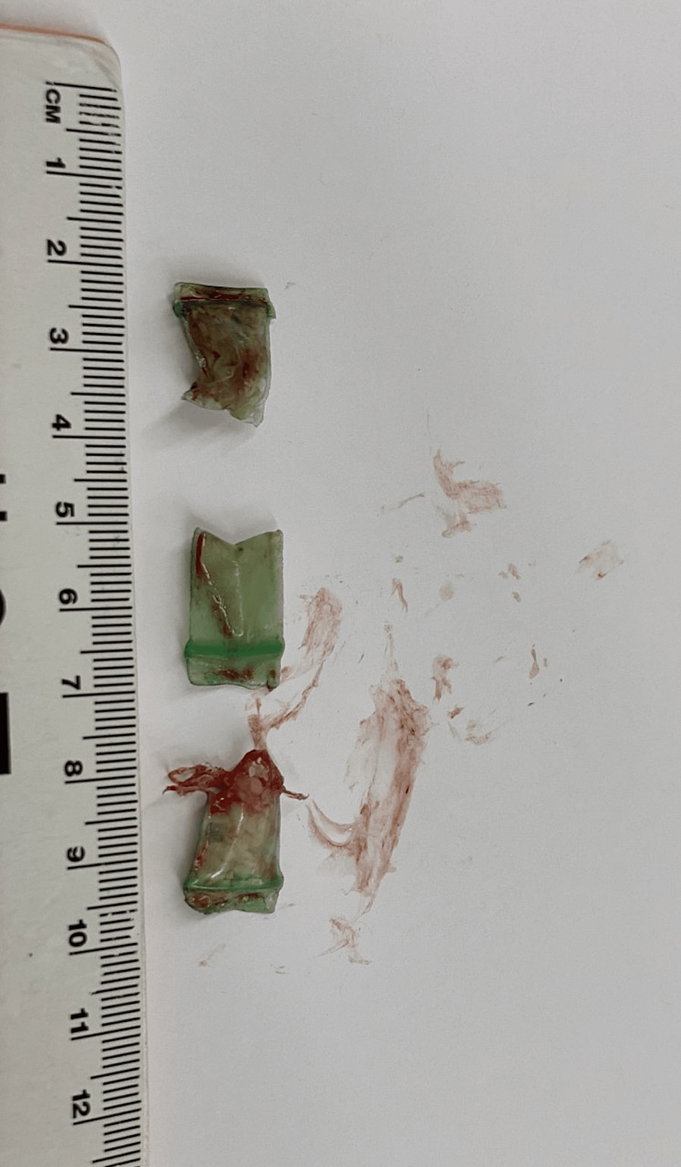 Three-plastic-bags,-about-1-x-0.5-cm-in-size,-containing-an-unknown-substance,-were-extracted-by-alligator-forceps-from-the-left-mainstem-bronchus.