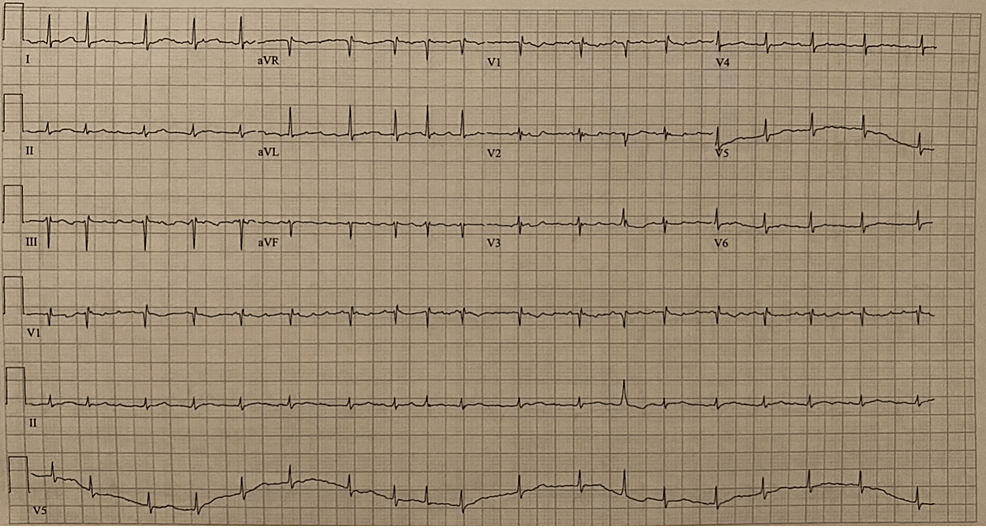 EKG-on-presentation-showing-new-atrial-fibrillation-with-rapid-ventricular-response-as-well-as-low-voltage-in-precordial-leads