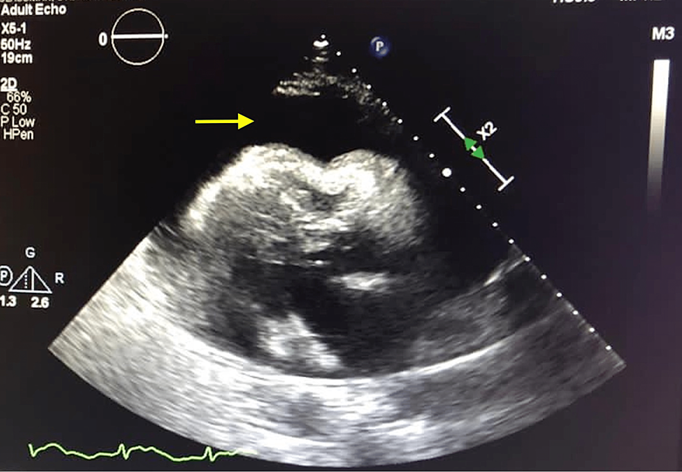2D-transthoracic-echocardiogram-on-admission-showing-large-pericardial-effusion-with-diastolic-collapse-of-right-ventricle-consistent-with-tamponade-physiology