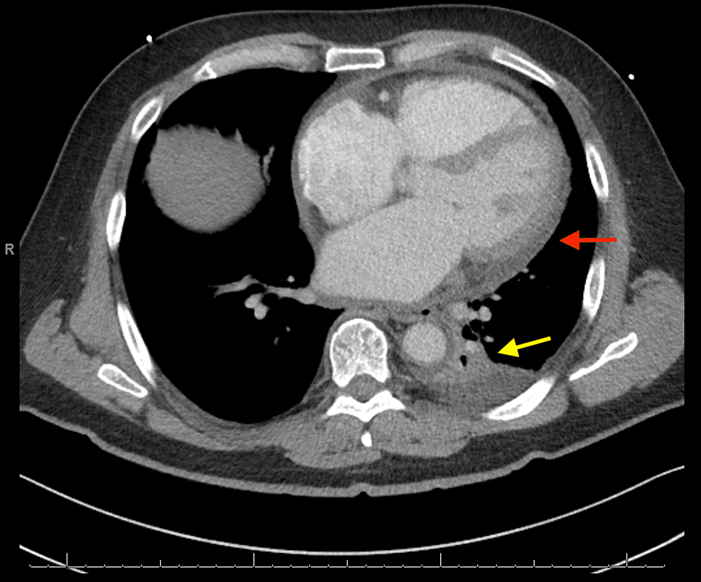 CT-chest-showing-a-small-pericardial-effusion-as-well-as-a-left-lower-lobe-infiltrate