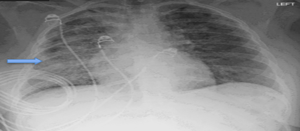 Cureus Vaping Induced Lung Injury With Superimposed Mycoplasma