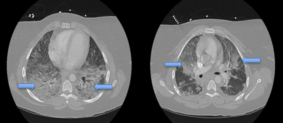 CT-chest-axial-view