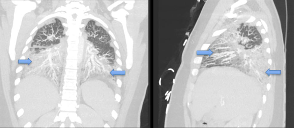 CT-chest-coronal-and-sagittal-views