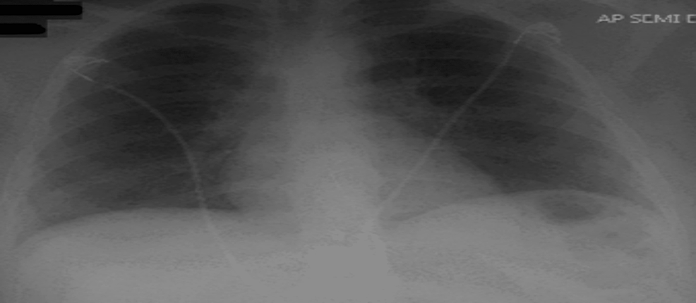 CXR-with-resolved-bilateral-opacities.