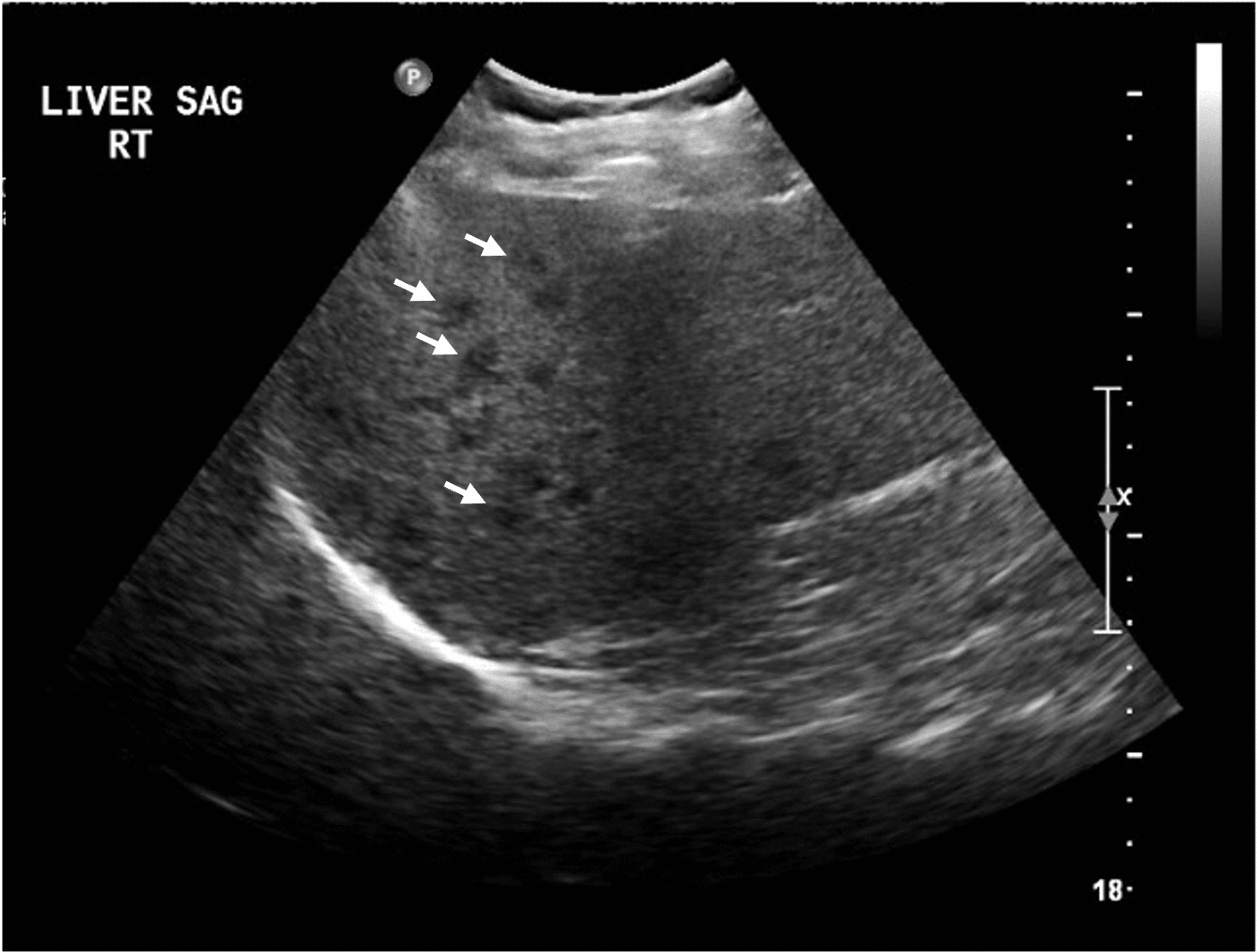 Cureus Far From the Biliary Tree A Case of Overlapping Autoimmune