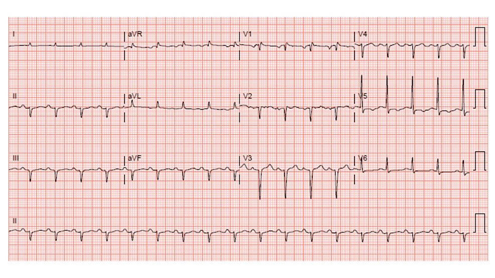 Electrocardiogram-at-hospital-admission