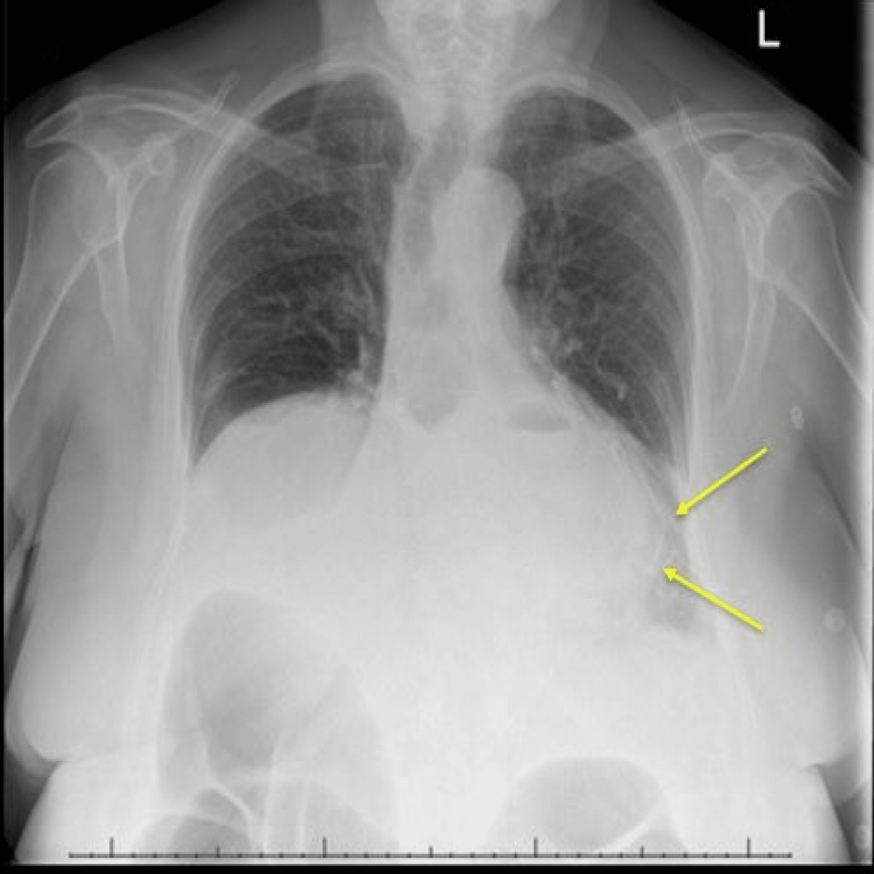 Gastric Volvulus Diagnosis And Successful Endoscopic De Rotation Towards Conservative