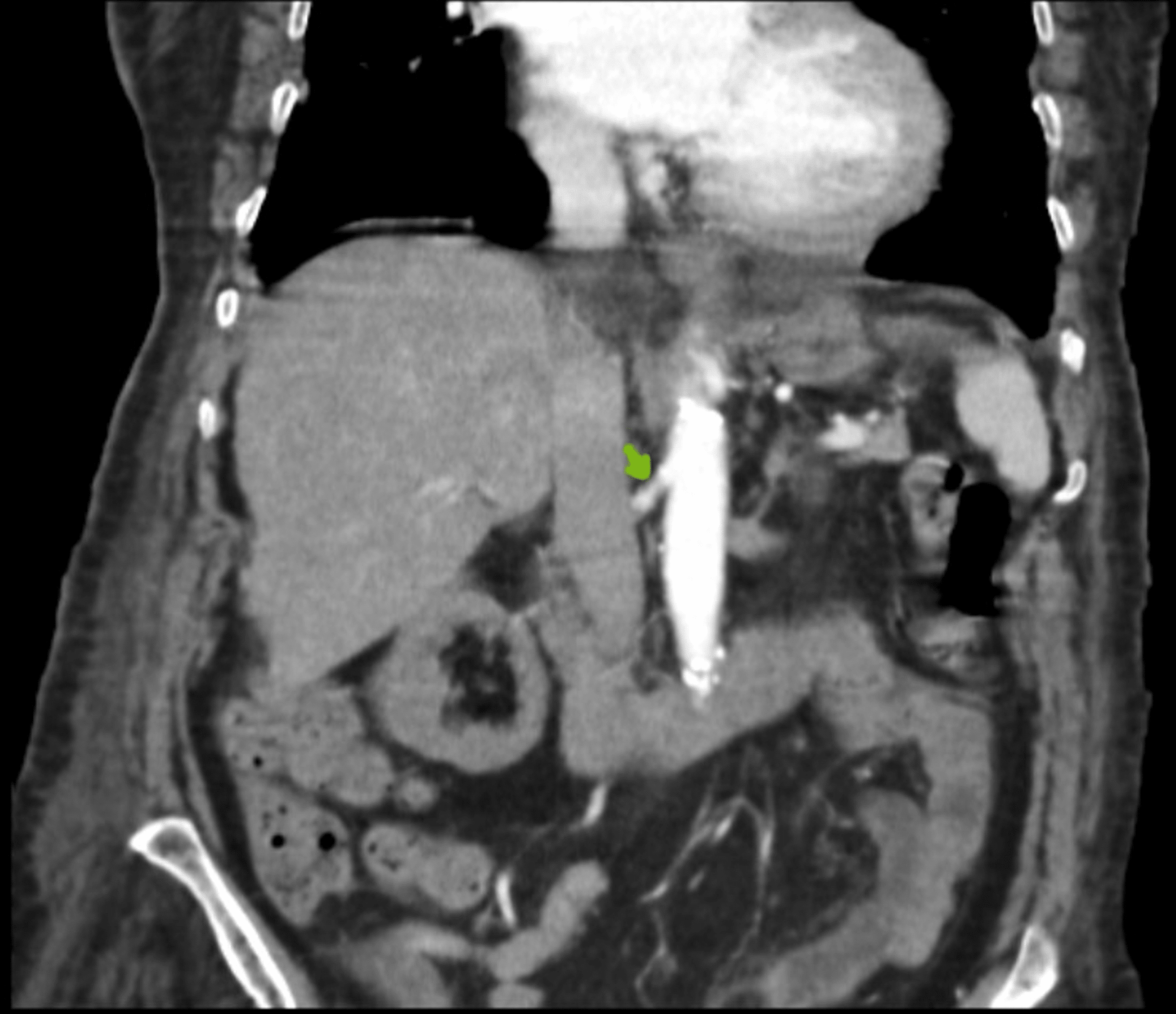 Cureus Bilateral Renal Artery Thrombosis A Case of Successful Kidney