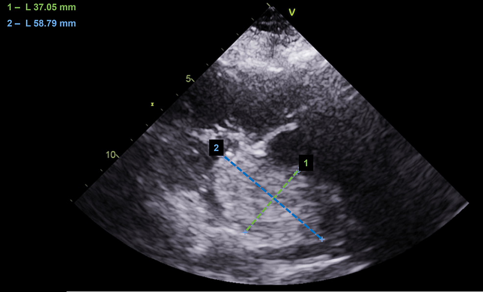 Transthoracic-echocardiogram-showing-the-left-atrium-filled-with-a-mass-measuring-approximately-60x40-mm.
