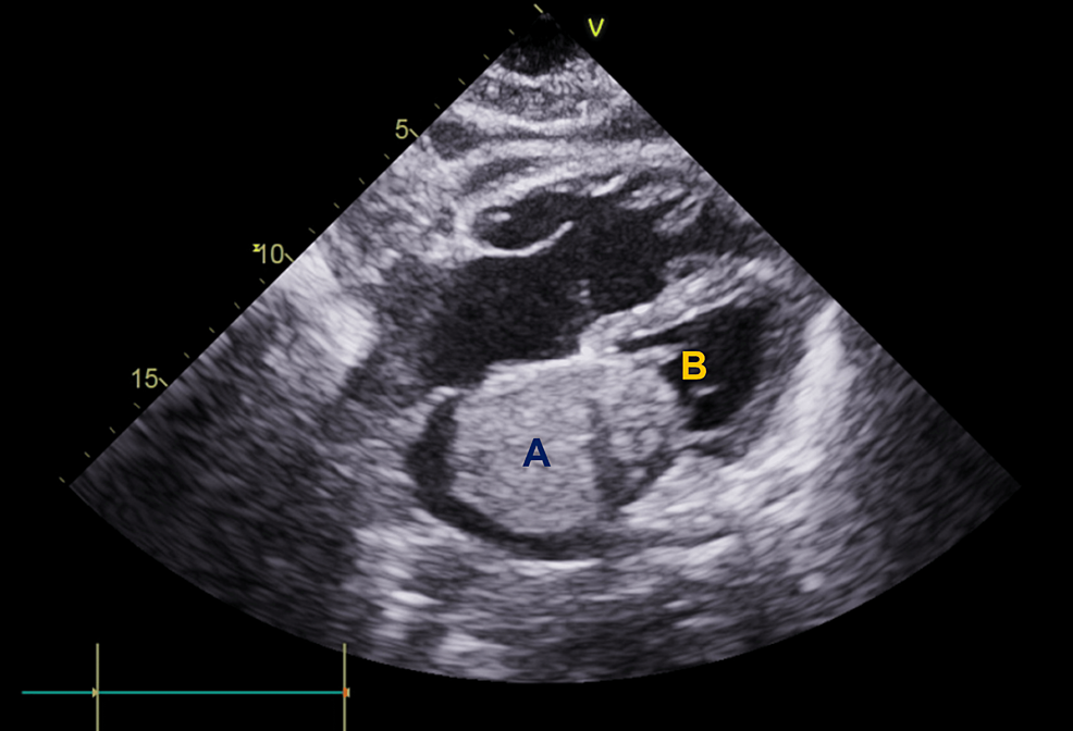 Transthoracic-echocardiogram-with-a-clear-intracardiac-mass-(A)-obstructing-the-mitral-valve-(B)-in-diastole.