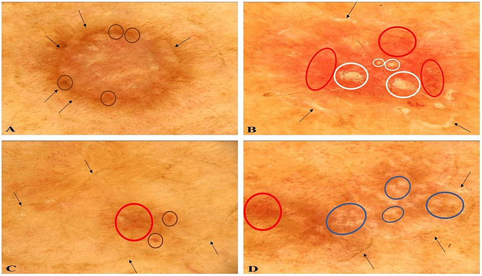 Aspectos dermatoscópicos de las lesiones de poroqueratosis actínica superficial diseminada (DSAP) vistas con un dermatoscopio polarizado