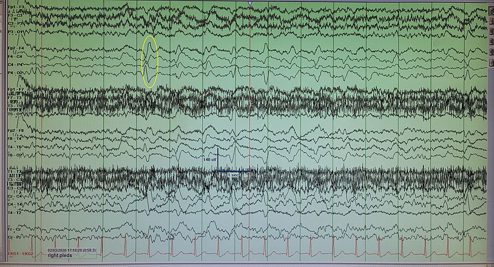 EEG-displaying-LPDs-(yellow-oval)-at-0.5-1-Hz-in-the-right-hemisphere