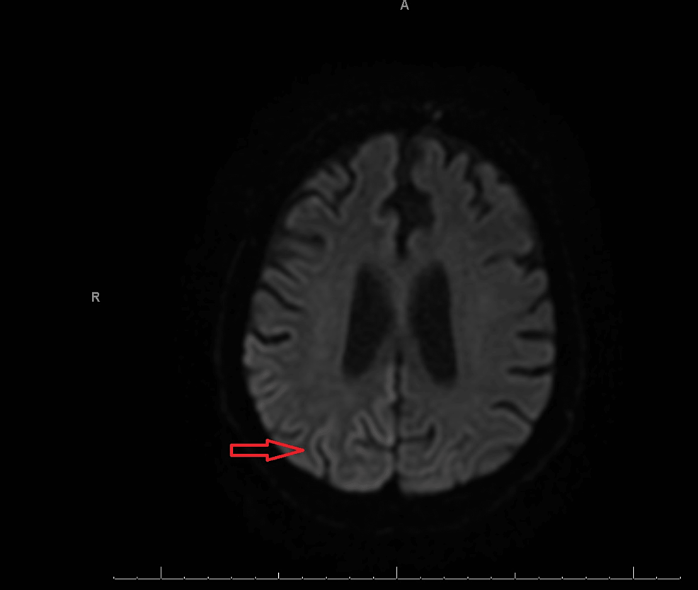 MRI-of-the-brain-(DWI)-without-contrast-displaying-areas-of-curvilinear-hyperintense-signal-in-the-right-temporo-occipital-cortex-(red-arrow)