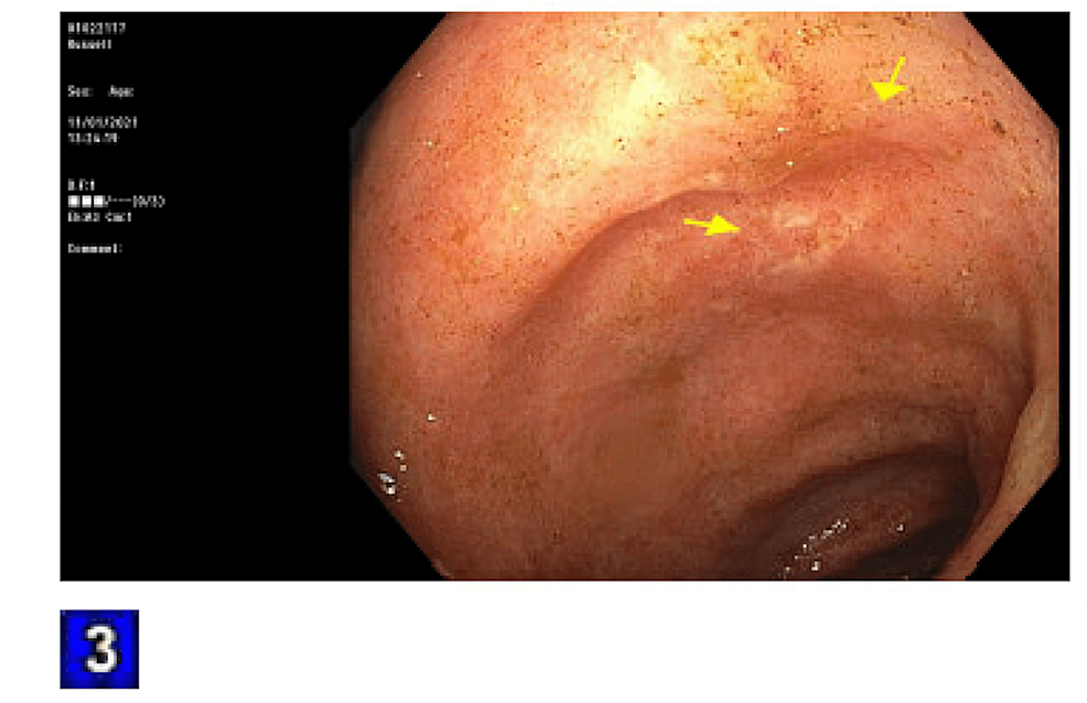 Cureus | Mycophenolate Mofetil-Induced Cytomegalovirus Colitis In A ...