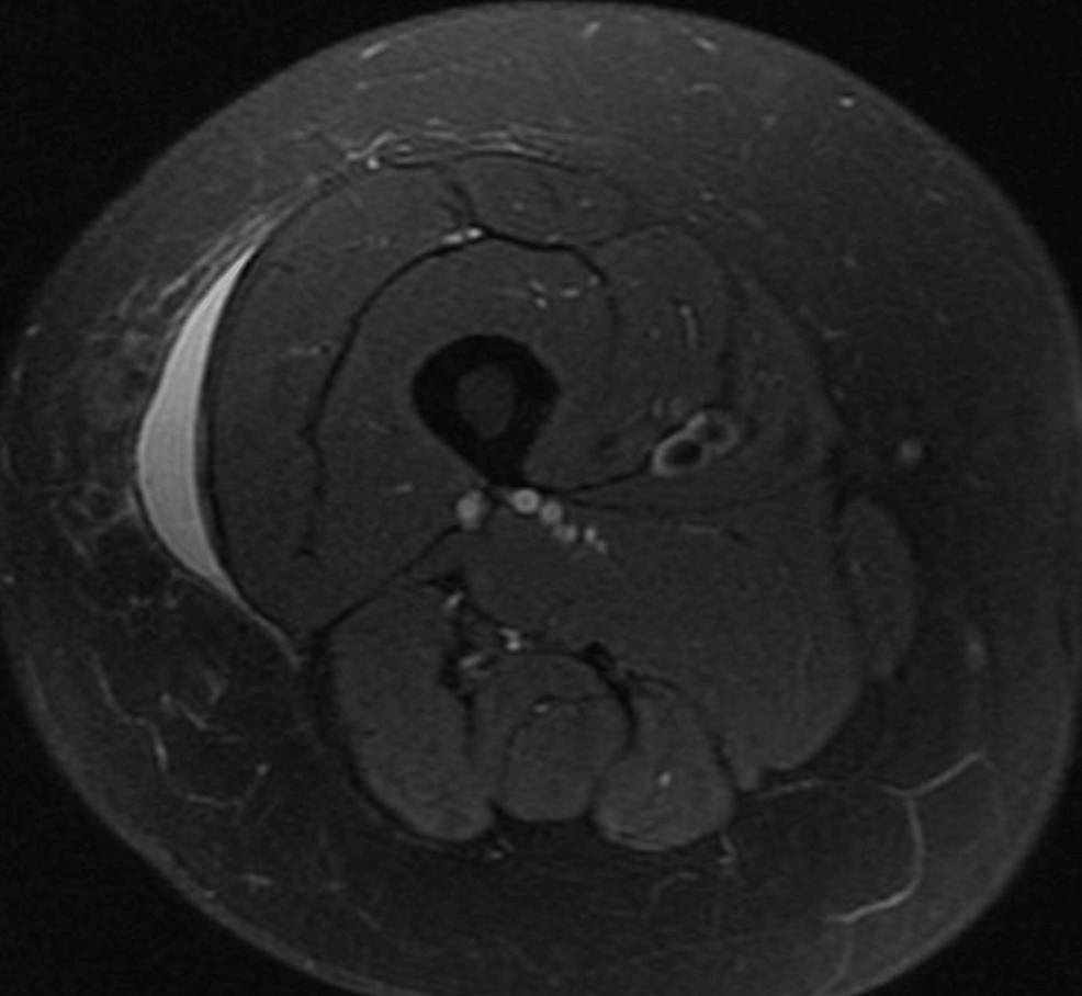 Cureus MorelLavallée Lesions A Diagnostic and Clinical Dilemma