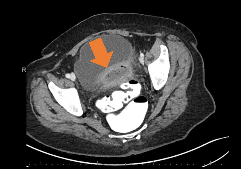 Preoperative-CT-scan-demonstrating-thick-walled,-mildly-enhancing-complex-fluid-collection-anterior-to-the-sigmoid-colon-consistent-with-a-perisigmoid-abscess-of-diverticular-origin.
