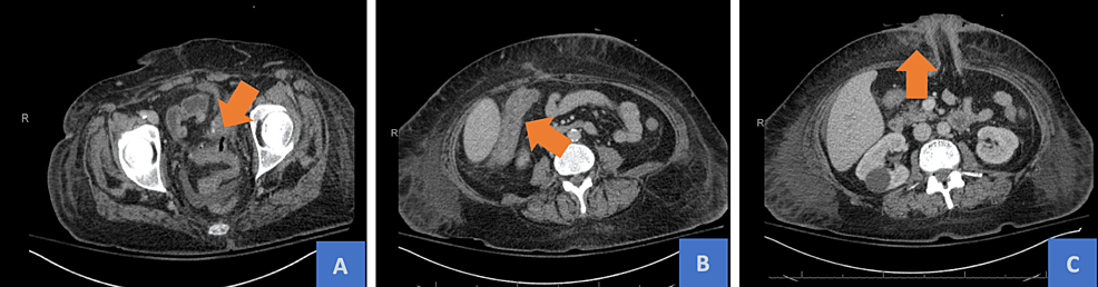 (A)-Interval-improvement-of-perisigmoid-fluid-collection-after-fecal-diversion.-(B)-Wall-thickening-with-associated-fat-stranding-of-the-ascending-and-proximal-transverse-colon-concerning-for-colitis.-(C)-Persistent-body-wall-edema-without-subcutaneous-emphysema.
