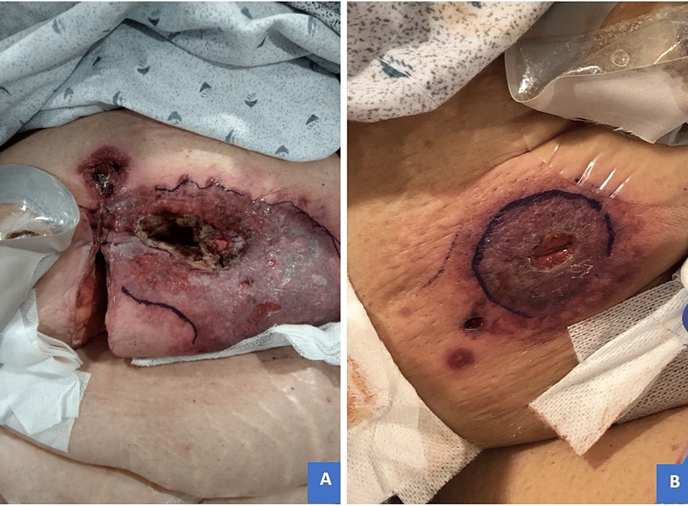 Pre-corticosteroid-treatment-imaging-of-cutaneous-eruptions.-(A)-Peristomal-region:-confluent-ulceration-with-central-necrotic-tissue-overhanging-demarcated-violaceous-border-extending-to-and-involving-midline-incision-three-days-after-re-exploration.-(B)-Laparoscopic-port-site:-similar-discoloration-with-central-skin-breakdown-and-characteristic-satellite-lesions-at-the-port-site.