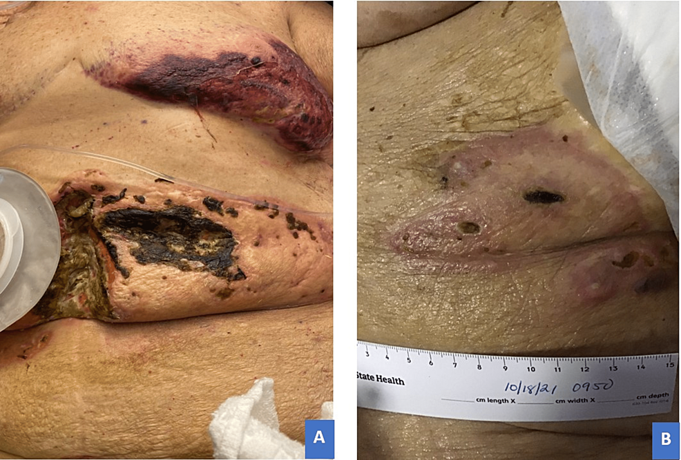 Post-corticosteroid-treatment,-day-28:-dramatic-improvement-of-cutaneous-lesions-showing-border-collapse,-fading-discoloration-with-central-eschar,-and-skin-dimpling/scarring.-(A)-Peristomal-region.-(B)-Laparoscopic-port-site.