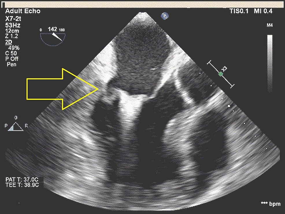 Cureus | Use of MitraClip for Postmyocardial Infarction Mitral ...