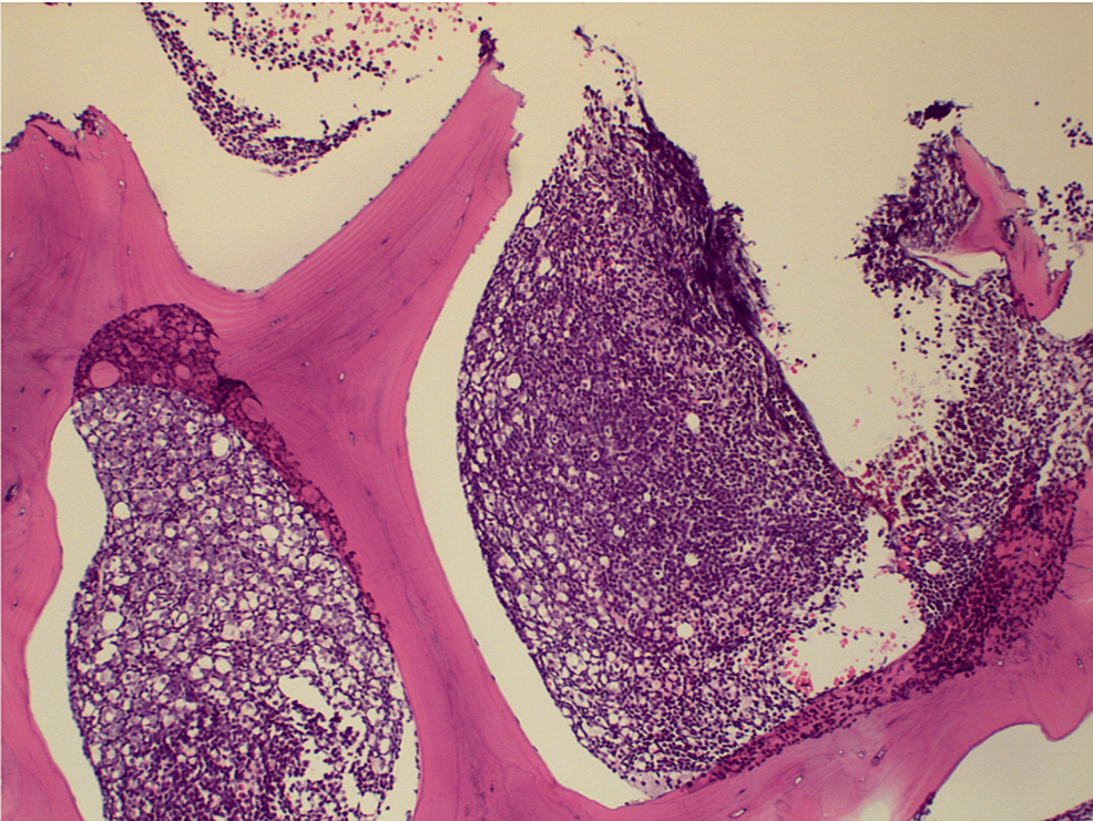 Bone-marrow-biopsy-showing-a-hypercellular-marrow-(10×).