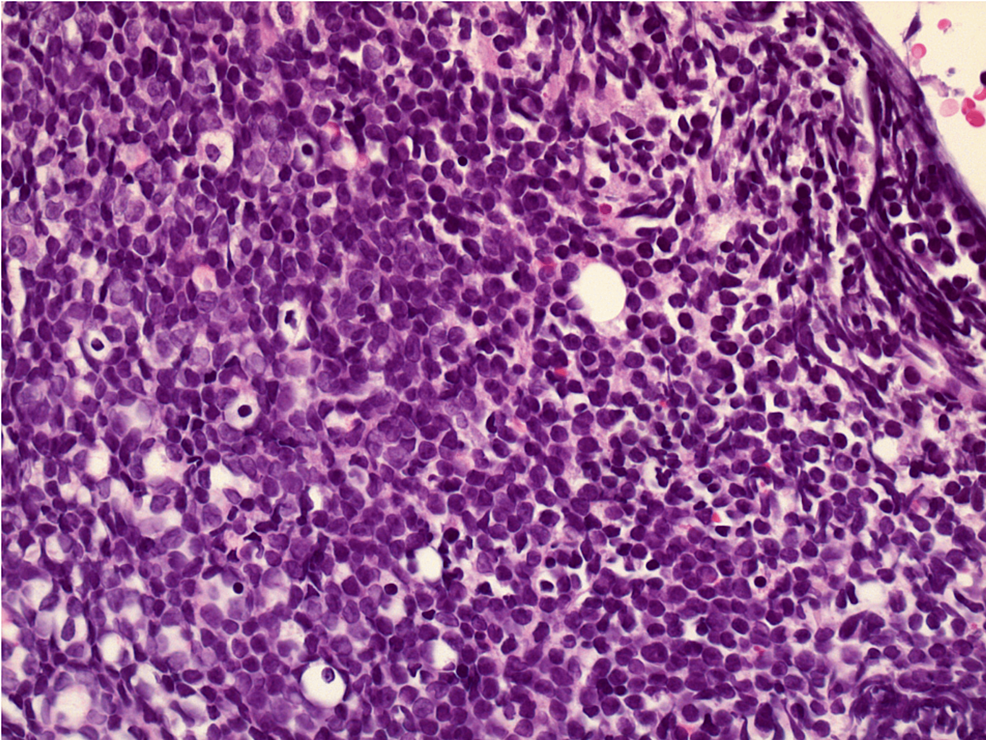 Hypercellular-bone-marrow-secondary-to-acute-B-cell-lymphocytic-leukemia-(40×).
