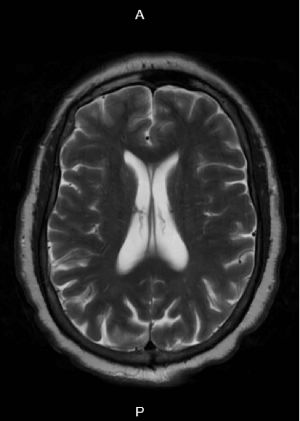MRI-brain