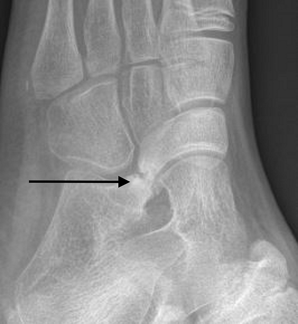 cureus-results-of-nonoperative-treatment-for-symptomatic-tarsal