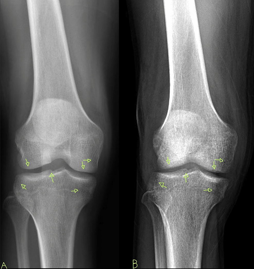 Pane-A-shows-the-initial-knee-X-ray.-Pane-B-shows-the-follow-up-knee-X-ray-with-damage-to-the-articular-surface-and-evidence-of-osteopenia.