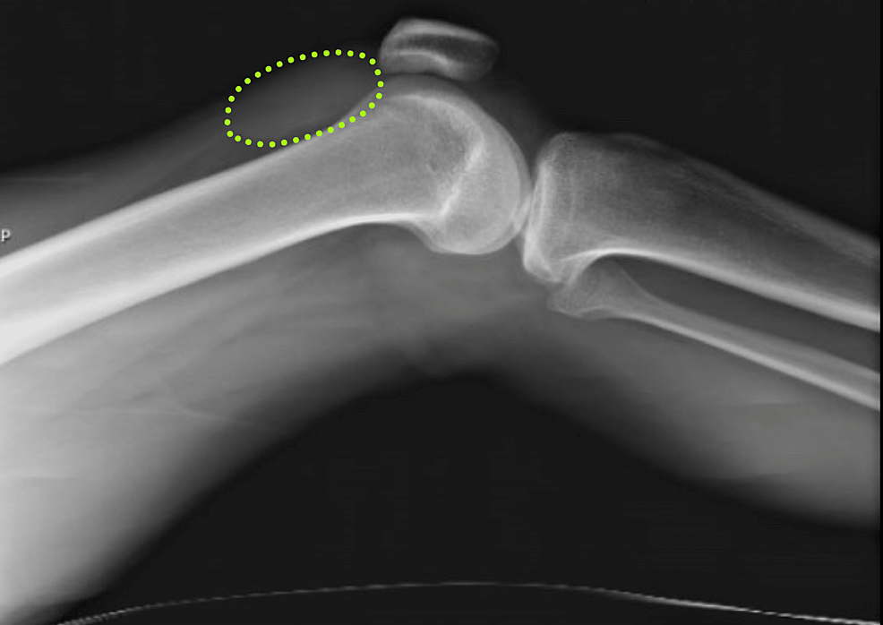 Initial-knee-X-ray-revealing-effusion-(traced-in-green).