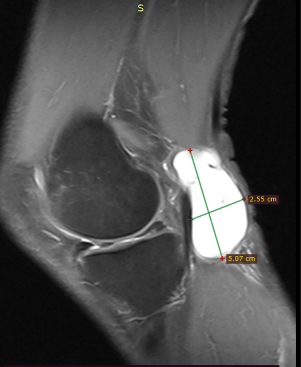 Cureus | Tibial Nerve Palsy: An Atypical Presentation of a Popliteal Cyst