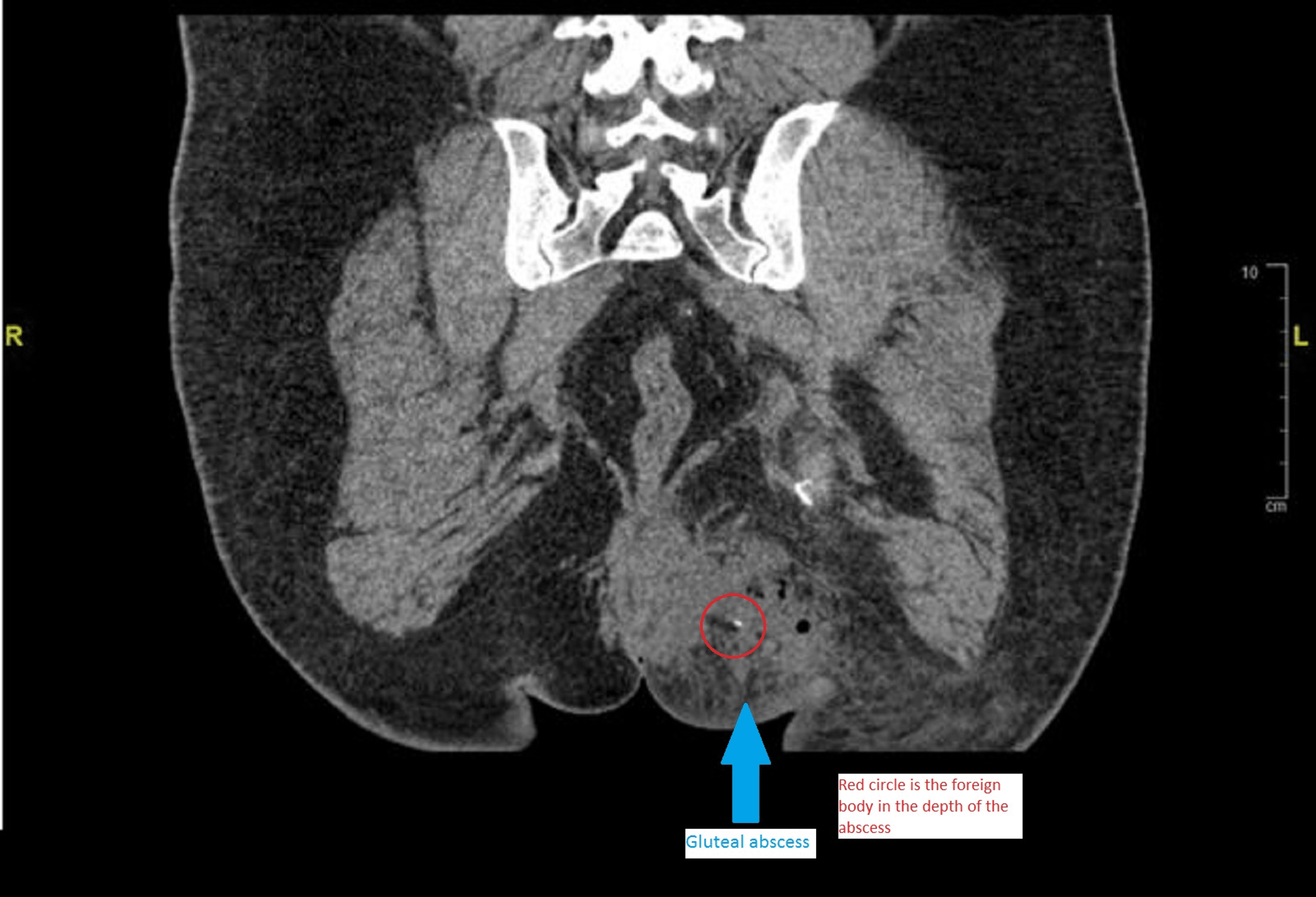 Patient S Ct Scan Showing Gluteal Muscle Abscess Down - vrogue.co