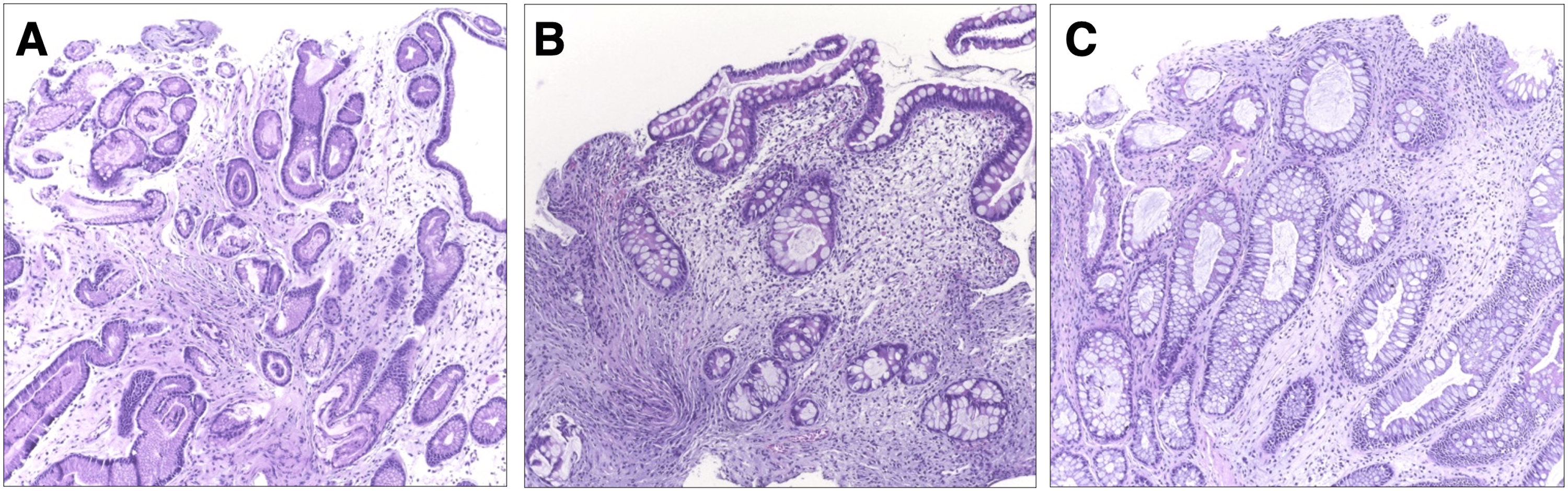 Cureus | Cronkhite-Canada Syndrome: A Rare Case of Chronic Diarrhea ...