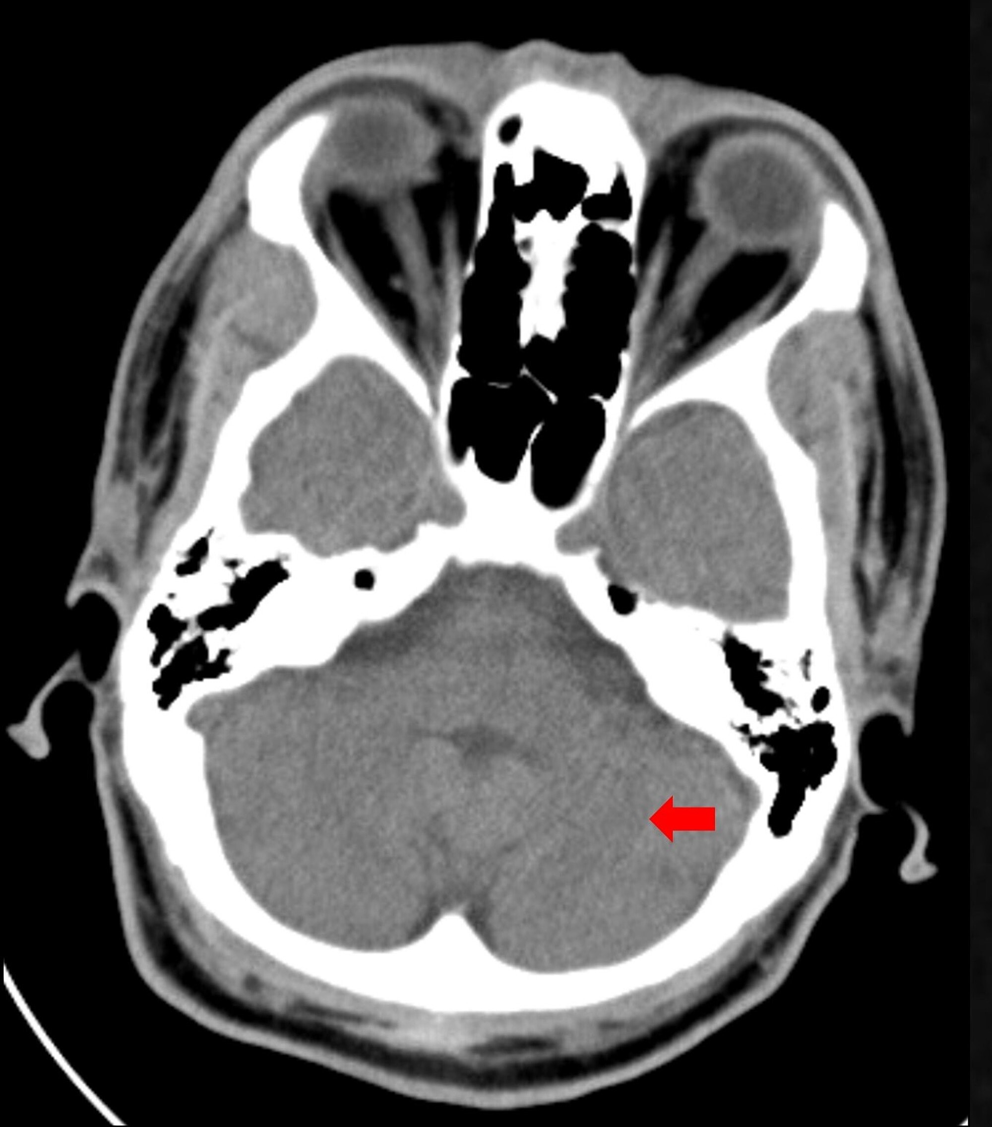 Echocardiogram Mitral Annular Calcification