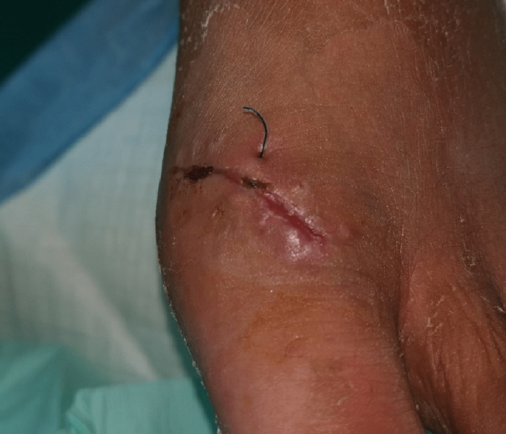 Suture-remnant-after-inadequate-self-removal-of-non-absorbable-sutures