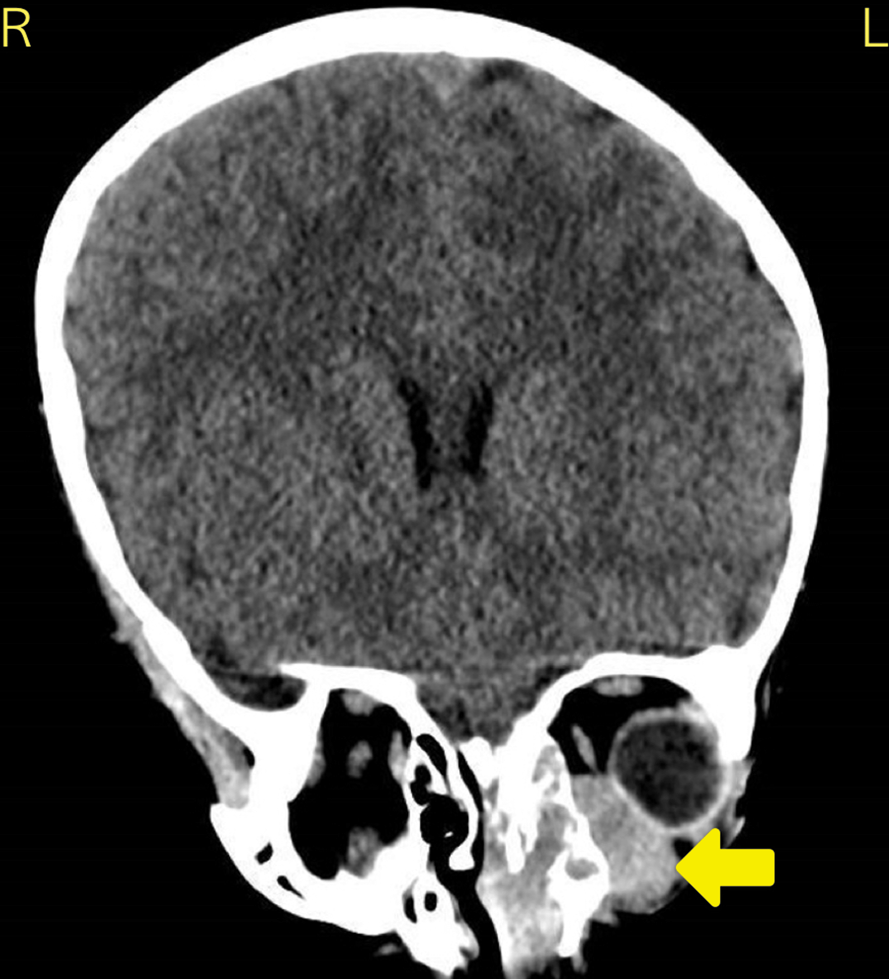 cureus-acute-leukemia-presenting-in-the-pediatric-orbit