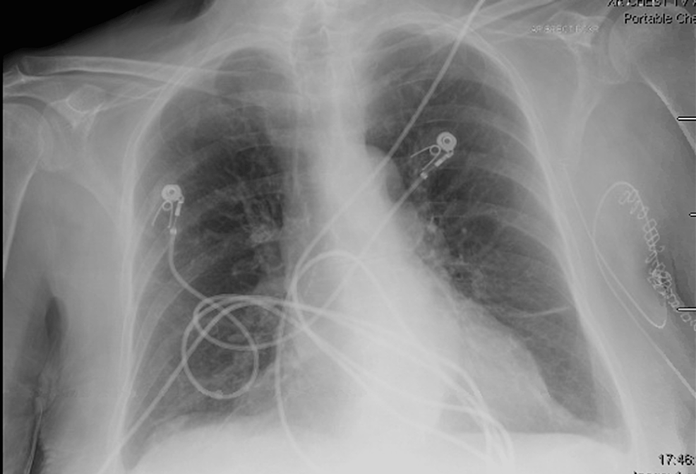 Chest-X-ray-taken-on-initial-presentation-in-the-Emergency-Room.-There-was-no-evidence-of-cardiomegaly,-interstitial-or-lobar-infiltrates,-cephalization-of-pulmonary-vessels,-or-other-findings-consistent-with-heart-failure.