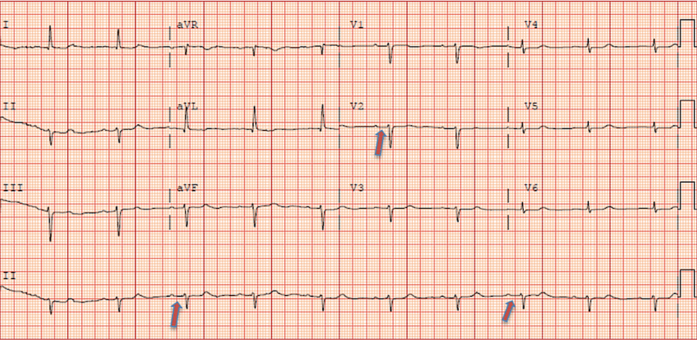 12-lead-EKG-showing-bradycardia-with-first-degree-AV-block.--