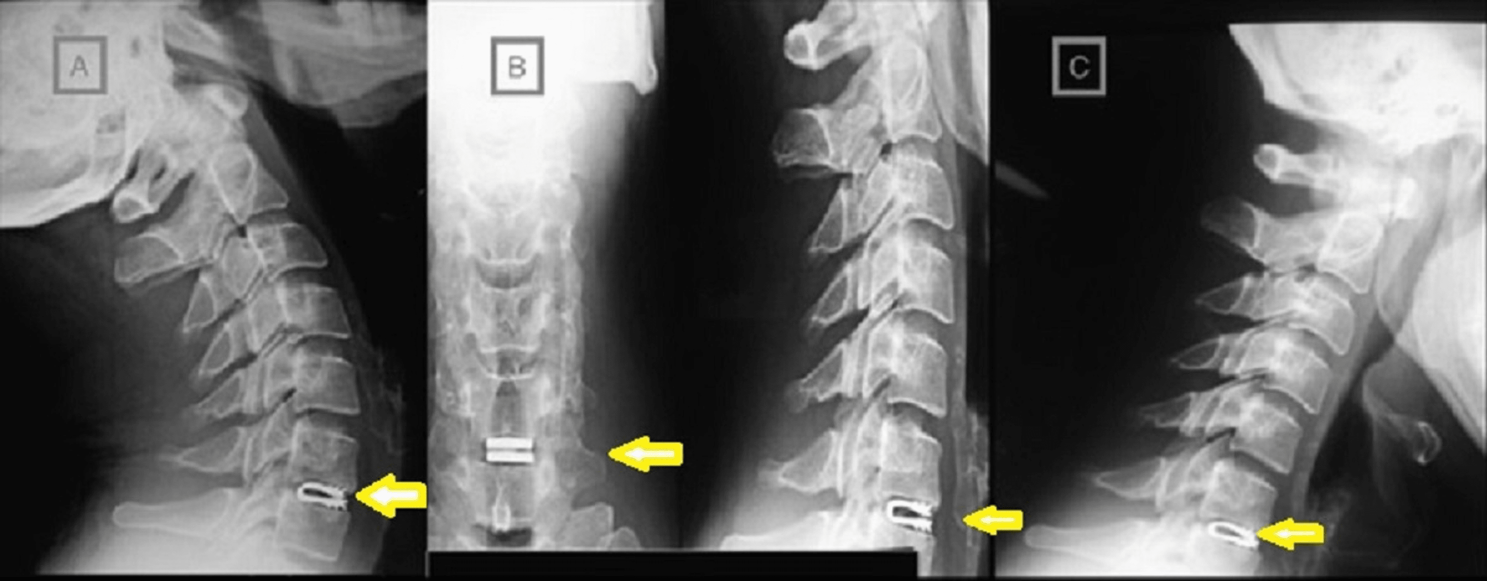 Cureus | Dynamic Cervical Implants in Patients With Disc Degenerative ...