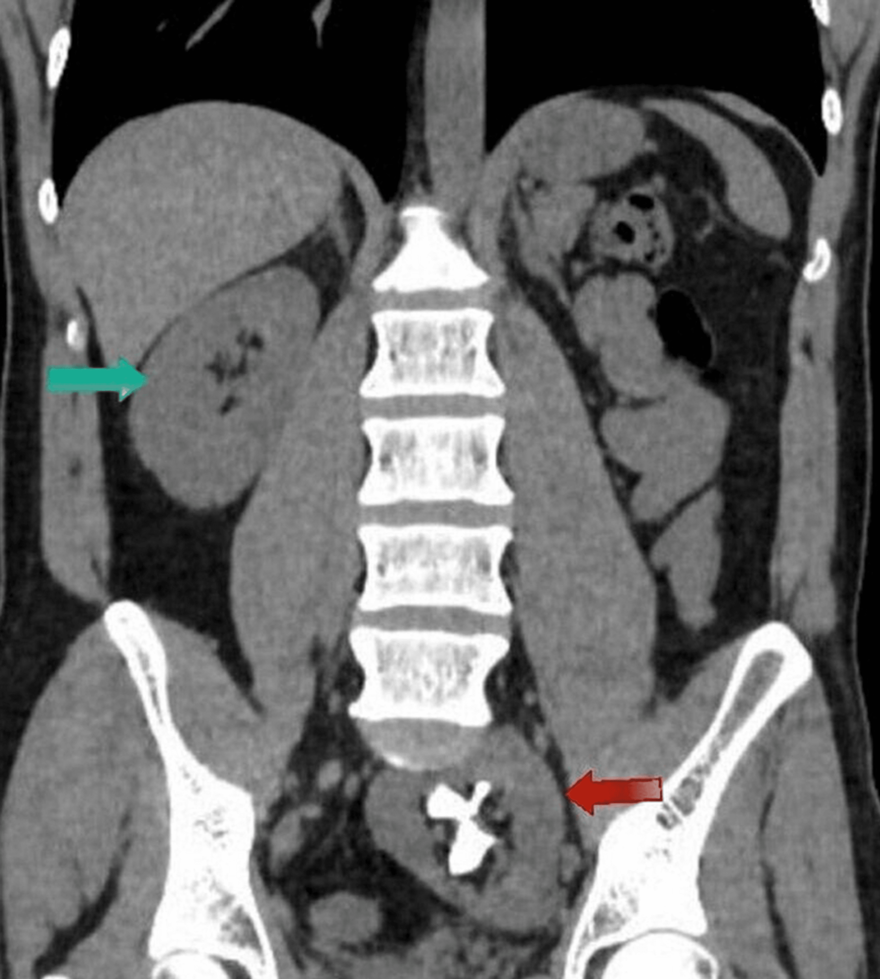 Cureus LaparoscopyAssisted Percutaneous Nephrolithotripsy (PCNL) in