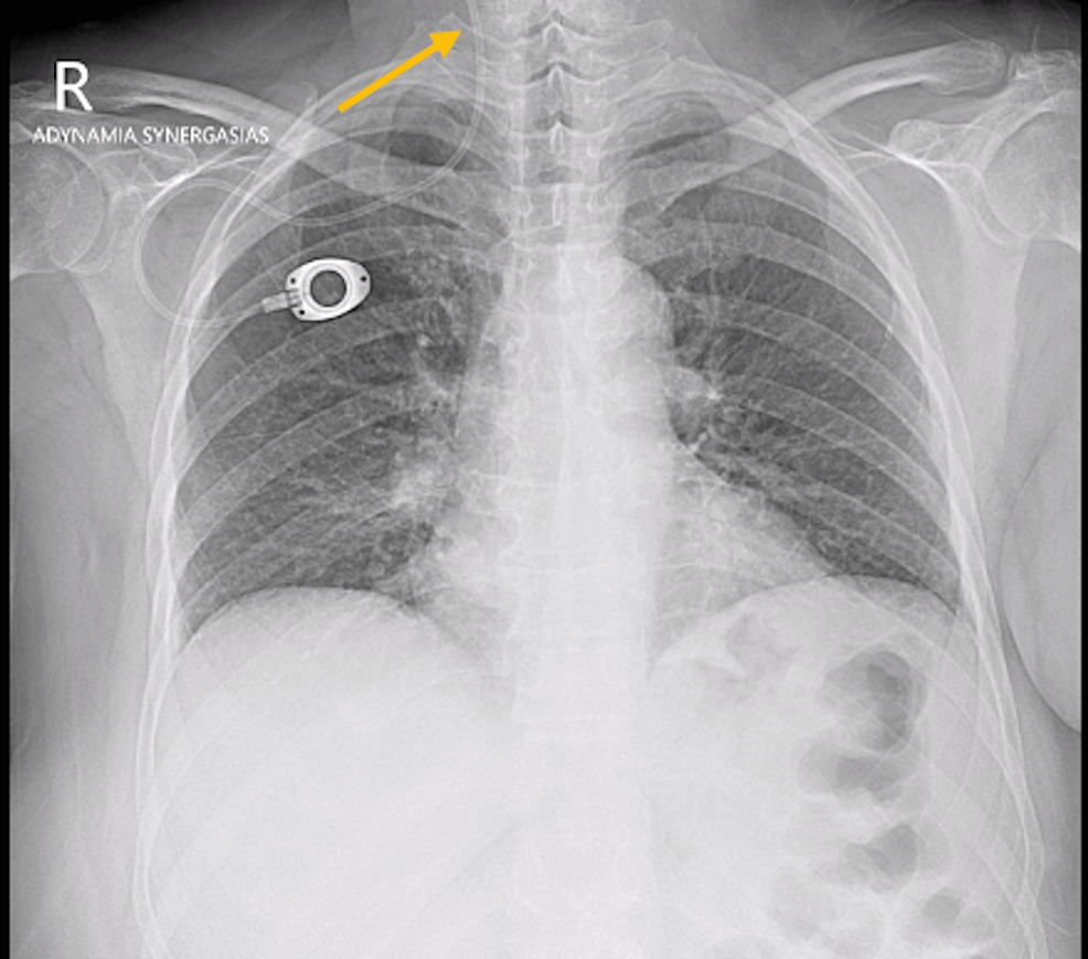 Cureus Asymptomatic Spontaneous Migration of the Tip of PortACath