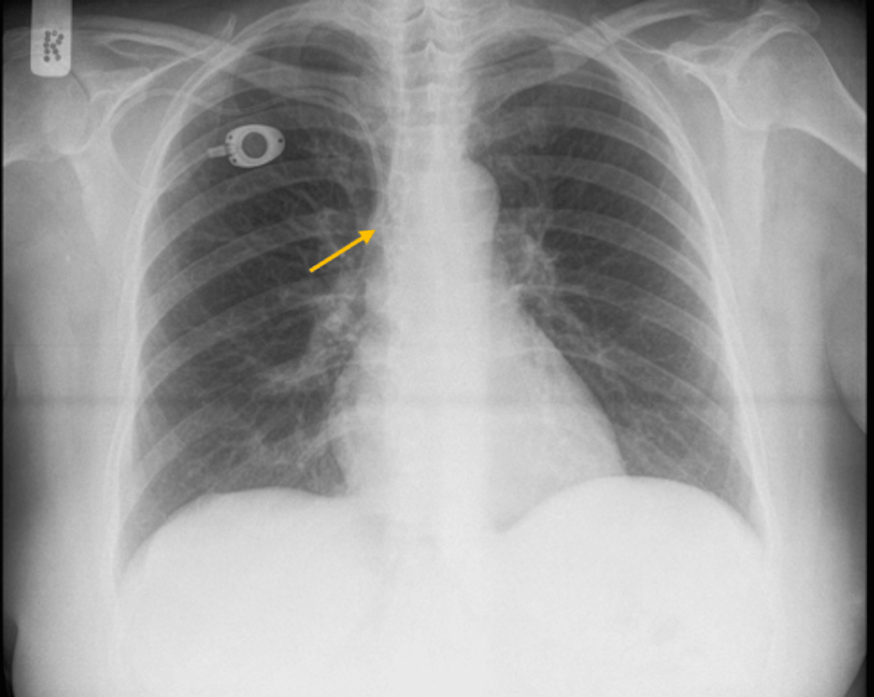 Cureus Asymptomatic Spontaneous Migration of the Tip of PortACath