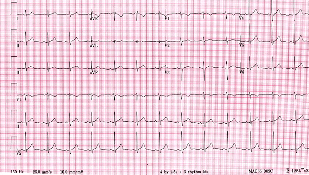 Cureus, Atypical Presentation of Scarlet Fever