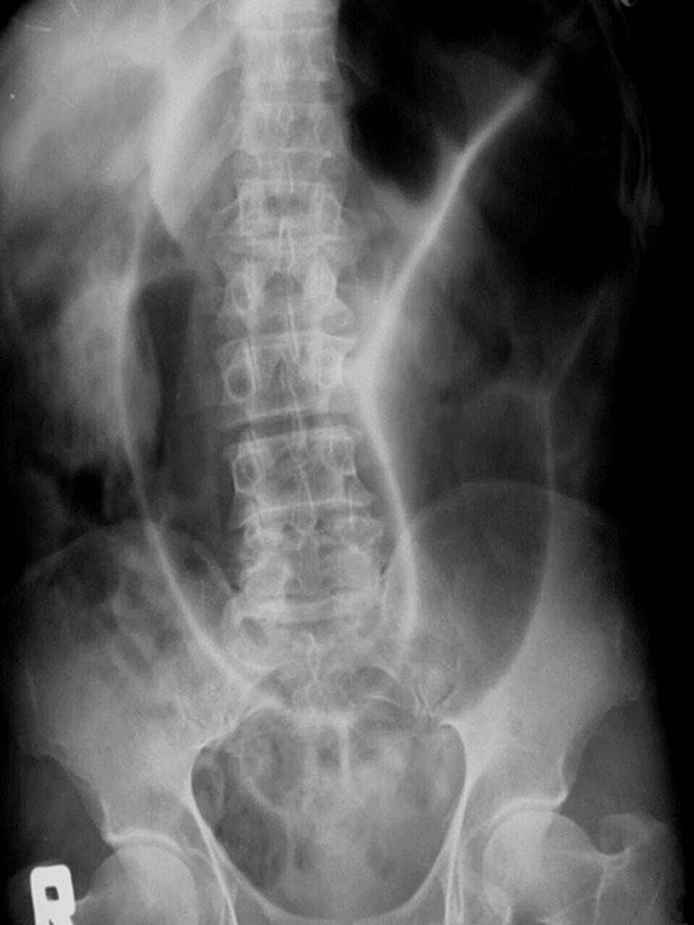 Cureus | Pediatric Sigmoid Volvulus: A Report on Two Cases