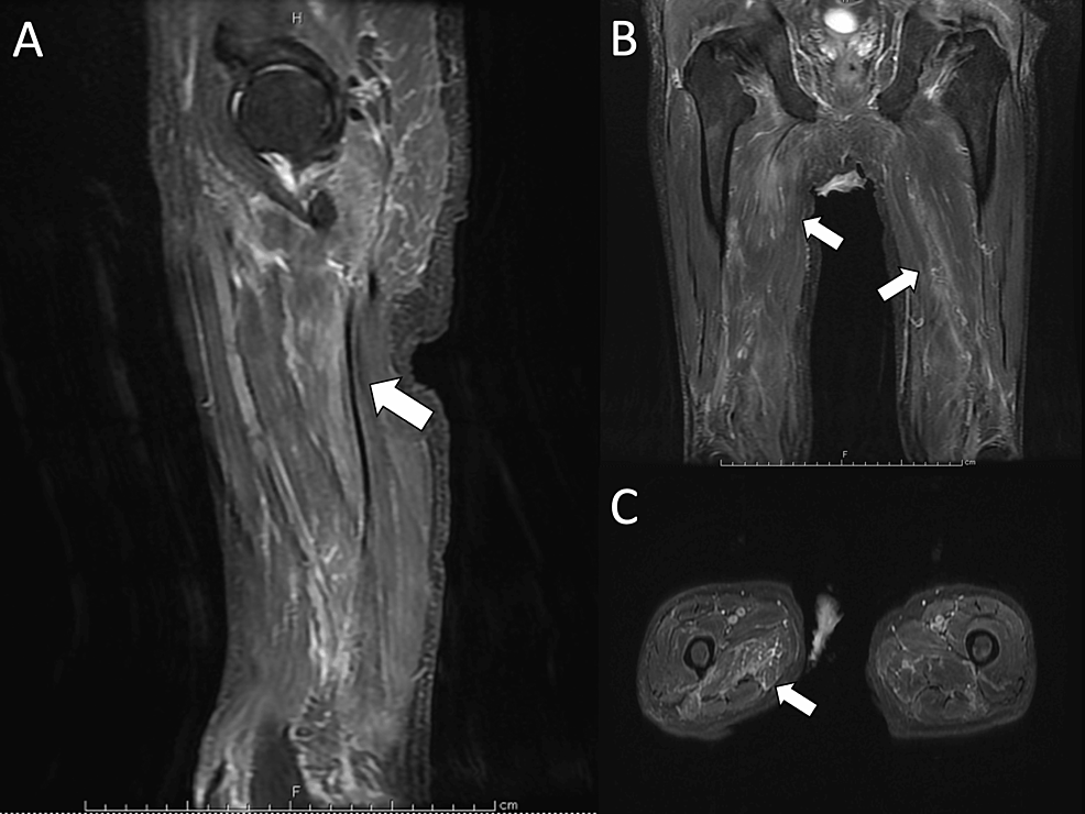 Short-TI-inversion-recovery-images-of-thigh-muscle-groups-(A:-Sagittal,-B:-Coronal,-C:-Transverse)-showing-muscle-inflammation-(white-arrow)