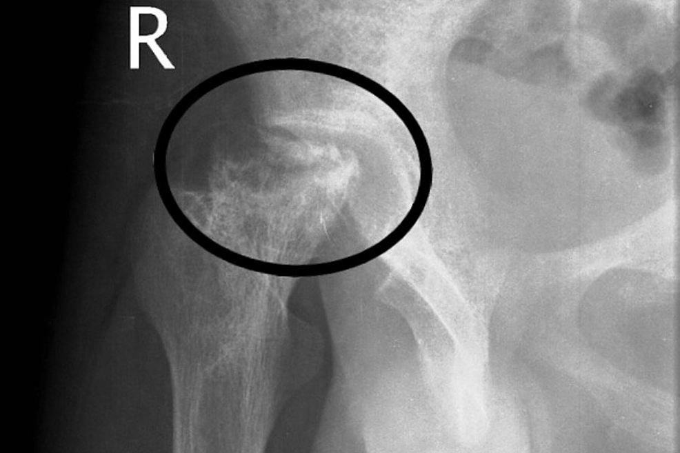 Cureus | Osteonecrosis of the Femoral Head: Etiology, Investigations ...