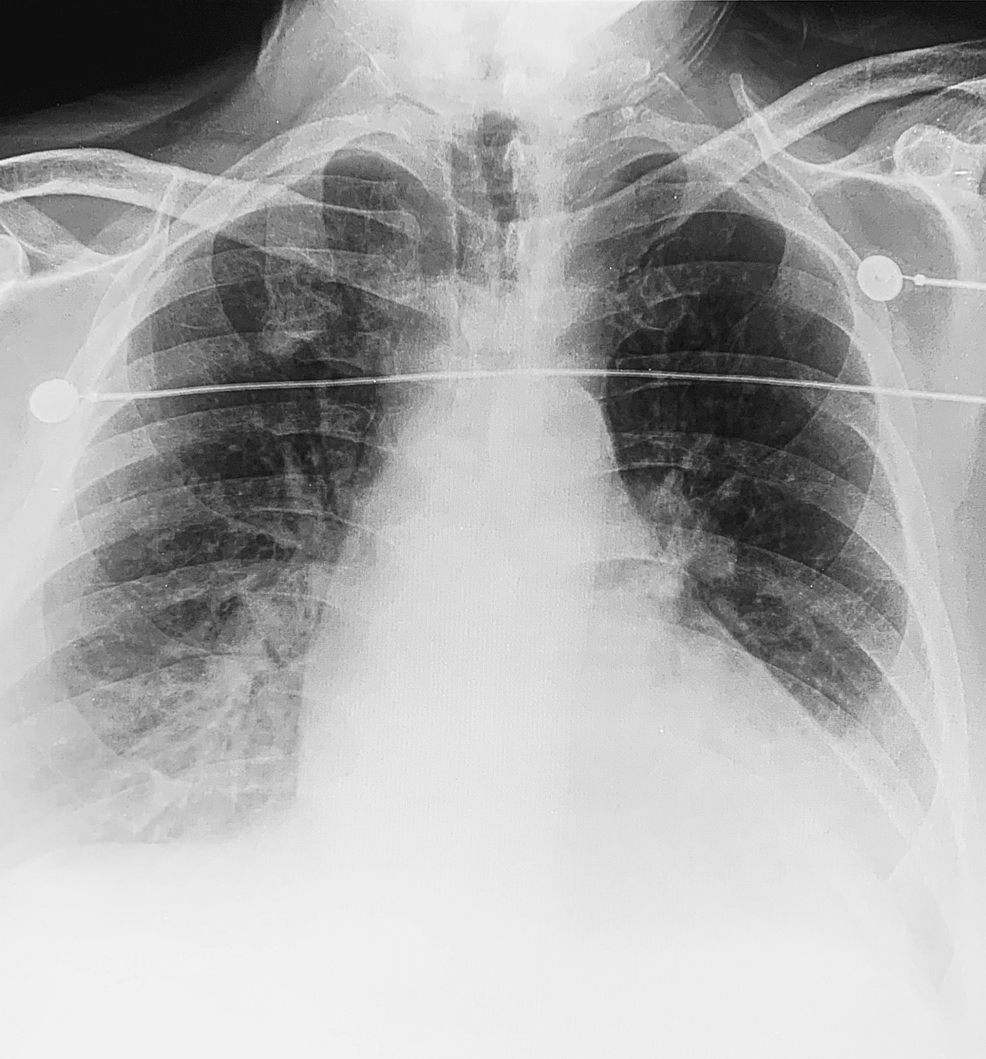 Chest-X-ray-demonstrating-bilateral-pulmonary-edema-and-cardiomegaly-supportive-of-CHF.