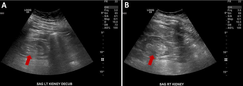 Abdominal-ultrasound-demonstrating-bilateral-renal-atrophy-with-diffusely-increased-echogenicity-bilaterally,-consistent-with-CKD.