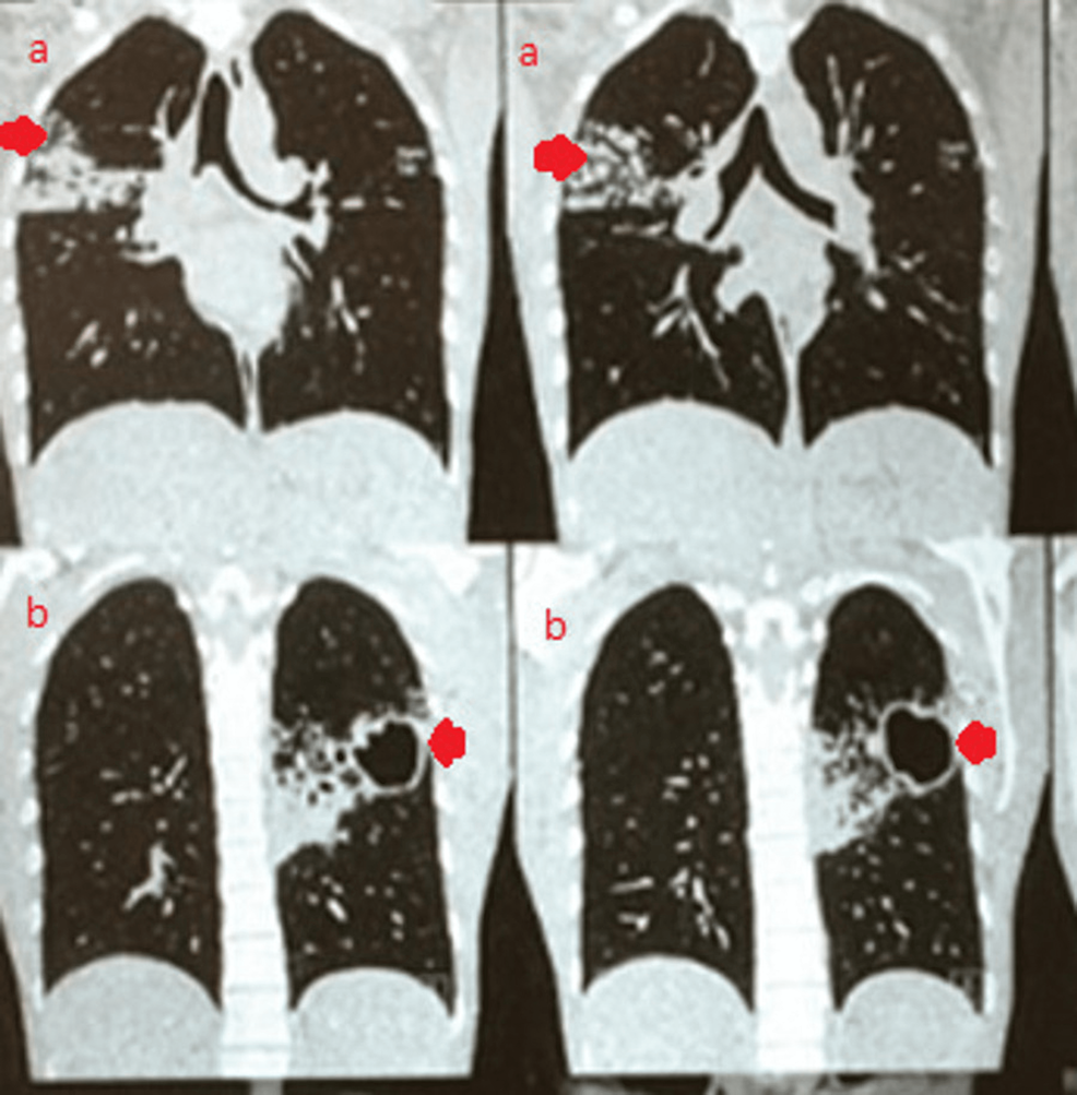 High-resolution-computed-tomography-(HRCT)-of-the-chest-showing-multiple-coalescing-cavitary-lesions-in-the-left-upper-lobe-with-peri-regional-nodular-and-alveolar-opacities-and-multiple-coalescing-nodular-and-alveolar-opacities-in-the-right-upper-lobe.
